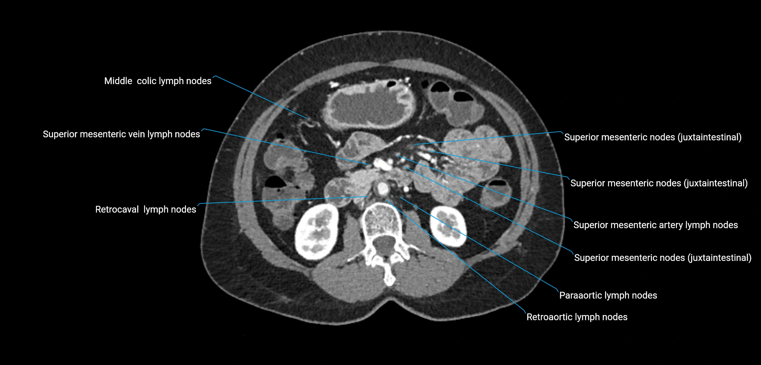 CT ct abdominal lymph nodes  axial cross sectional anatomy  enchanced radiology image -img-00002-00199.webp